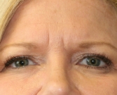 Feel Beautiful - Filler (hyaluronan) into squint lines - Before Photo